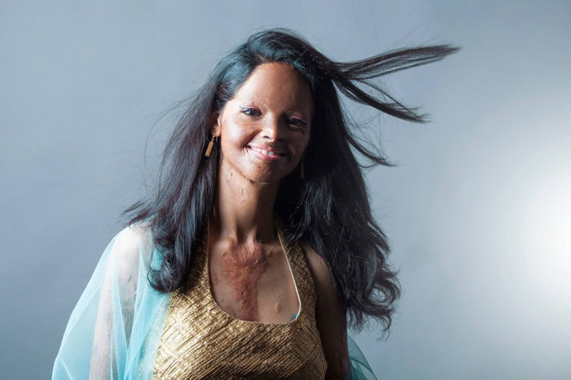 Inspirational Photos Show Acid Attack Survivors' Beauty 1